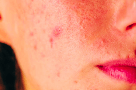 Melhor Sabonete Para Acne e Manchas